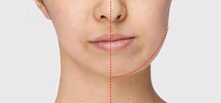 顔の骨が非対称に発達した場合、頬骨またはエラの手術で改善可能