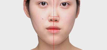 鼻が曲がっていて顔が非対称に見える場合、歪み鼻矯正術で改善可能
